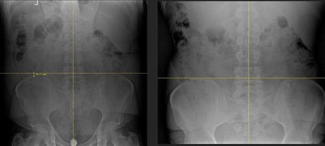 LOWER BACK PAIN & SCIATICA
