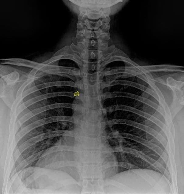 CHEST PAIN AND RIB ISSUES